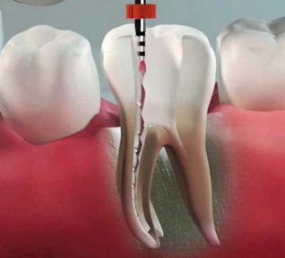 Endodontia Odontologia clínica