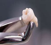 Extrações Dentárias