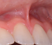 Frenectomia Odontologia