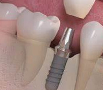 Implantodontia Odontologia