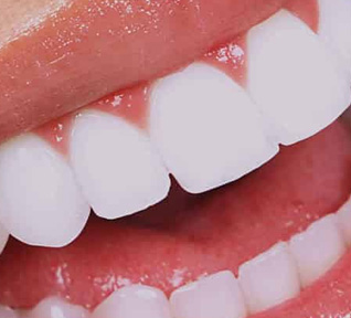 Lentes de Contato Dental Odontologia clínica