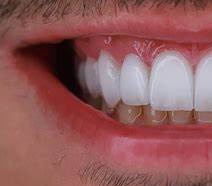 Lentes de Contato Dental Odontologia