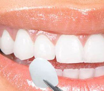 Lentes de Contato Dental Odontologia em SP